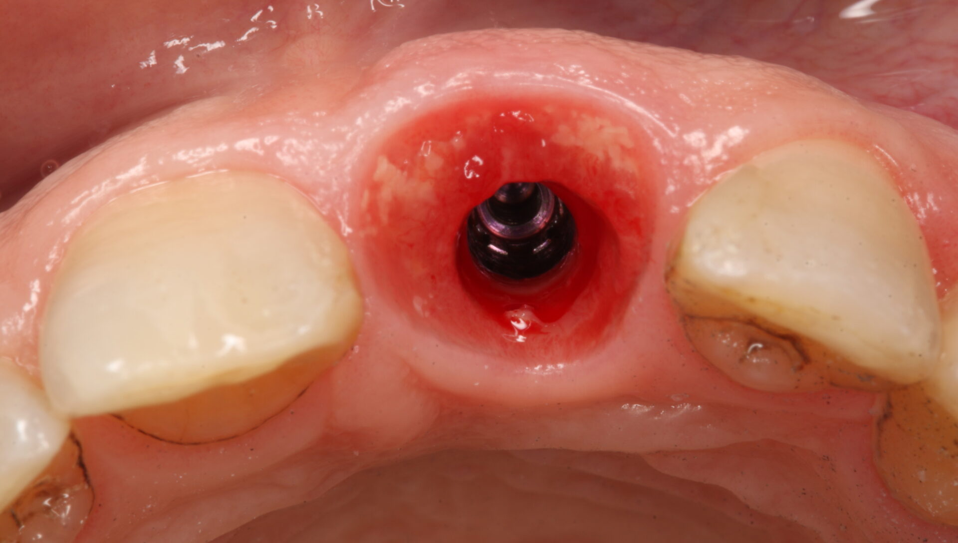 MasterClass ZBLC En Implantes Inmediatos - Zero Bone Loss Concepts